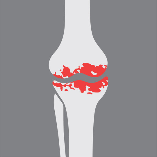 Osetoarthritis (OA)