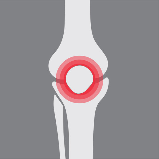 patellafemoral pain syndrome